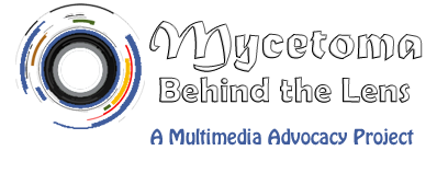 Mycetoma Behind the Lens